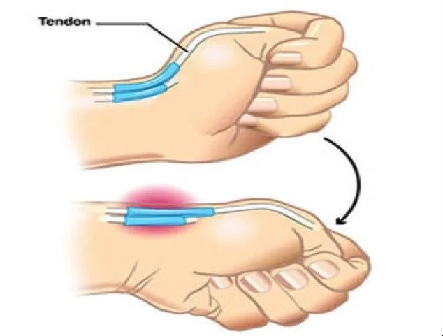 Anatomía de la tenosinovitis de De Quervain mostrando inflamación de tendones del pulgar